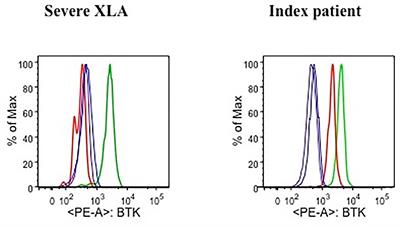 Case Report: A Case of X-Linked Agammaglobulinemia With High Serum IgE Levels and Allergic Rhinitis